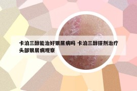 卡泊三醇能治好银屑病吗 卡泊三醇搽剂治疗头部银屑病观察