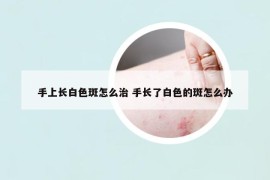 手上长白色斑怎么治 手长了白色的斑怎么办