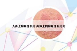 人身上癣用什么药 身体上的癣用什么药膏