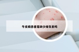 牛皮癣患者是缺少维生素吗