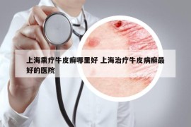 上海熏疗牛皮癣哪里好 上海治疗牛皮病癣最好的医院