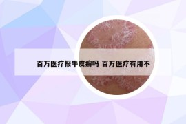 百万医疗报牛皮癣吗 百万医疗有用不