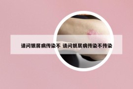 请问银屑病传染不 请问银屑病传染不传染