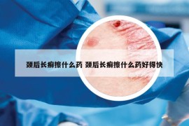 颈后长癣擦什么药 颈后长癣擦什么药好得快