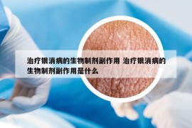 治疗银消病的生物制剂副作用 治疗银消病的生物制剂副作用是什么