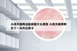 小孩大腿两边起癣是什么原因 小孩大腿两侧长了一大片红疹子