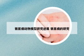 银屑病动物模型研究进展 银屑病的研究