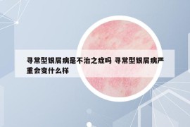 寻常型银屑病是不治之症吗 寻常型银屑病严重会变什么样