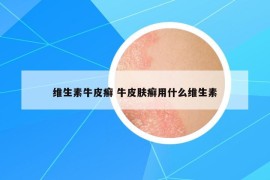 维生素牛皮癣 牛皮肤癣用什么维生素