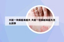 大腿一块癣越来越大 大腿一块癣越来越大怎么回事