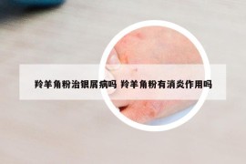 羚羊角粉治银屑病吗 羚羊角粉有消炎作用吗