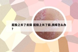 屁股上长了皮藓 屁股上长了藓,很痒怎么办?