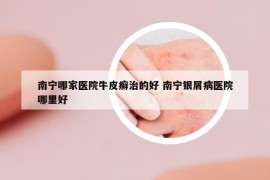 南宁哪家医院牛皮癣治的好 南宁银屑病医院哪里好