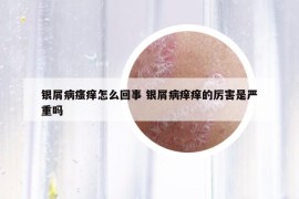 银屑病瘙痒怎么回事 银屑病痒痒的厉害是严重吗