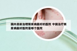 国内目前治理银屑病最好的医院 中国治疗银屑病最好医院是哪个医院