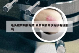 龟头银屑病和疱疹 银屑病和带状疱疹有区别吗