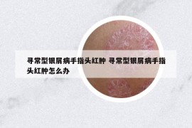 寻常型银屑病手指头红肿 寻常型银屑病手指头红肿怎么办