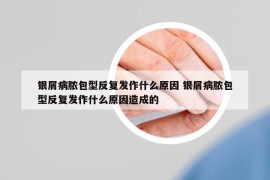 银屑病脓包型反复发作什么原因 银屑病脓包型反复发作什么原因造成的