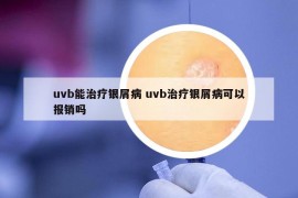 uvb能治疗银屑病 uvb治疗银屑病可以报销吗