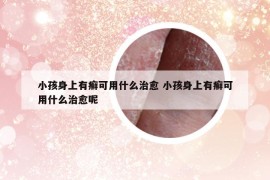 小孩身上有癣可用什么治愈 小孩身上有癣可用什么治愈呢