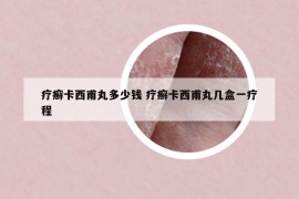 疗癣卡西甫丸多少钱 疗癣卡西甫丸几盒一疗程