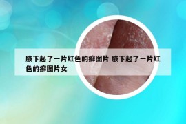 腋下起了一片红色的癣图片 腋下起了一片红色的癣图片女