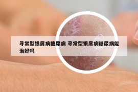 寻常型银屑病糖尿病 寻常型银屑病糖尿病能治好吗