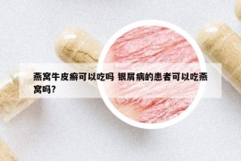 燕窝牛皮癣可以吃吗 银屑病的患者可以吃燕窝吗?