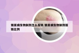 银屑病生物制剂怎么报销 银屑病生物制剂报销比例