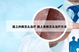 腿上的癣怎么治疗 腿上有癣怎么治疗方法