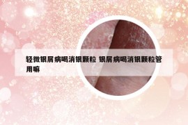 轻微银屑病喝消银颗粒 银屑病喝消银颗粒管用嘛