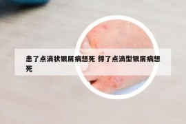 患了点滴状银屑病想死 得了点滴型银屑病想死