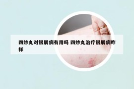 四妙丸对银屑病有用吗 四妙丸治疗银屑病咋样