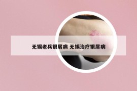 无锡老兵银屑病 无锡治疗银屑病