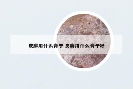 皮癣用什么膏子 皮癣用什么膏子好