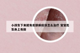 小孩生下来就有皮肤癣应该怎么治疗 宝宝出生身上有藓