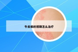 牛皮癣的初期怎么治疗