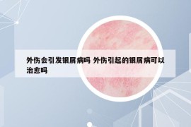 外伤会引发银屑病吗 外伤引起的银屑病可以治愈吗