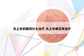 头上长的癣该什么治疗 头上长癣怎样治疗