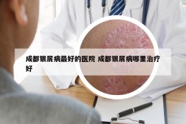 成都银屑病最好的医院 成都银屑病哪里治疗好