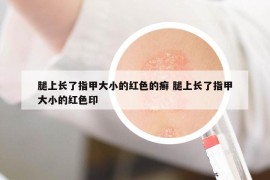 腿上长了指甲大小的红色的癣 腿上长了指甲大小的红色印