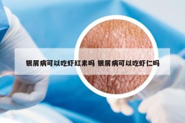 银屑病可以吃虾红素吗 银屑病可以吃虾仁吗