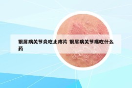 银屑病关节炎吃止疼片 银屑病关节痛吃什么药