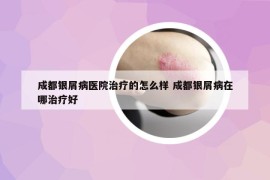 成都银屑病医院治疗的怎么样 成都银屑病在哪治疗好