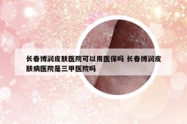 长春博润皮肤医院可以用医保吗 长春博润皮肤病医院是三甲医院吗