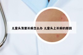 儿童头发里长癣怎么办 儿童头上长癣的原因