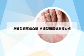 点滴型银屑病白斑 点滴型银屑病出现白点