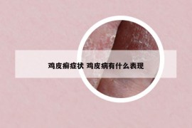 鸡皮癣症状 鸡皮病有什么表现