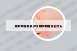 银屑病针刺多少钱 银屑病扎针能好么