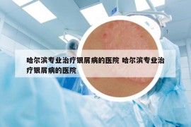 哈尔滨专业治疗银屑病的医院 哈尔滨专业治疗银屑病的医院